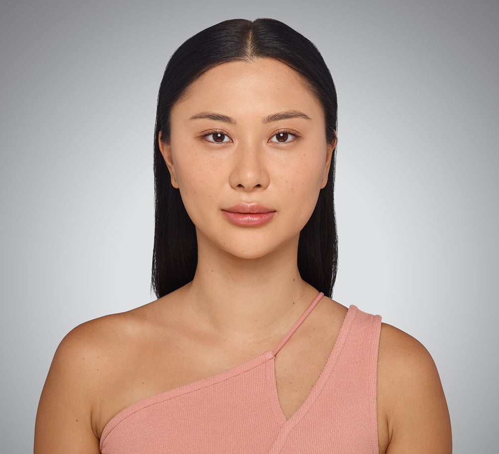 sara - cheeks, undereye, lips & jawline After Juvederm