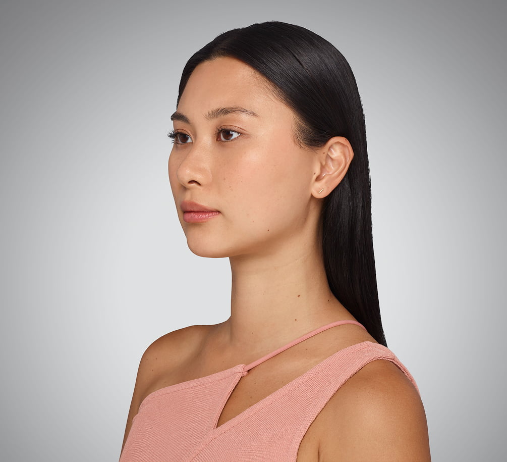 sara - cheeks, undereye, lips & jawline Before Juvederm