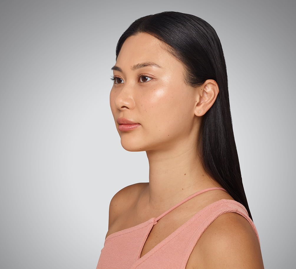 sara - cheeks, undereye, lips & jawline After Juvederm