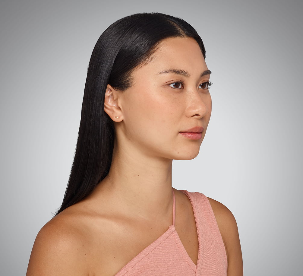 sara - cheeks, undereye, lips & jawline Before Juvederm