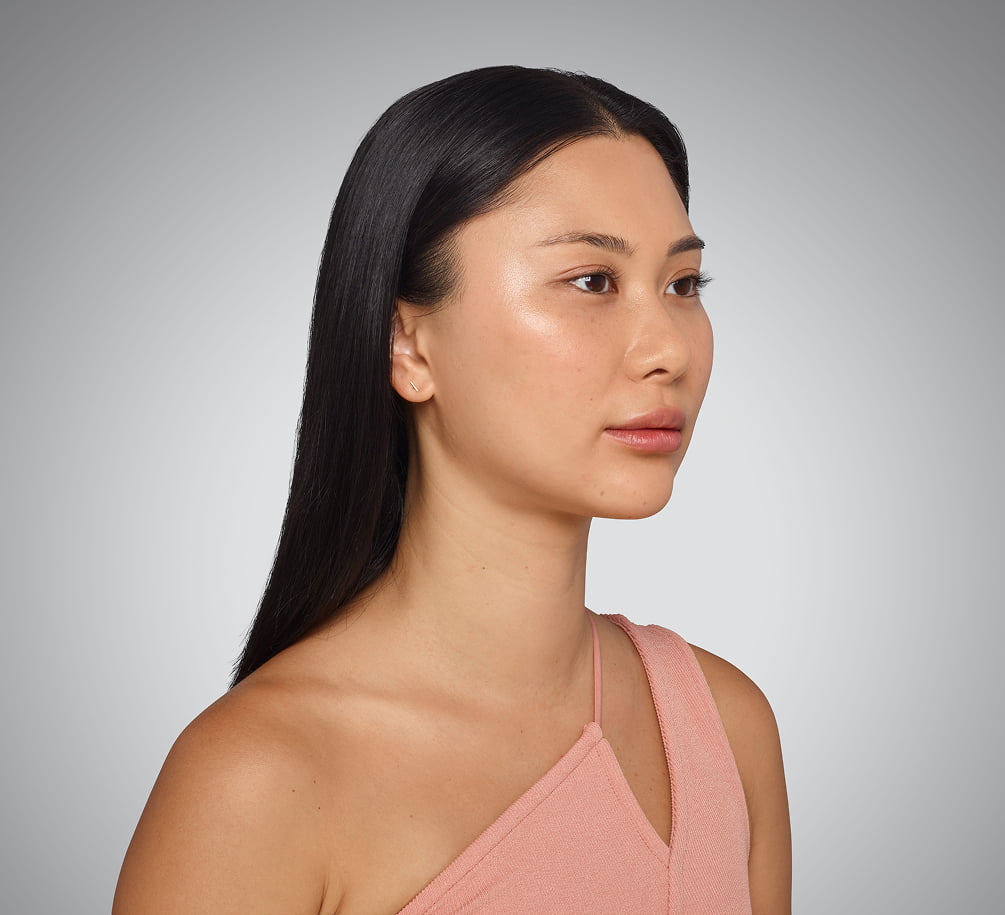 sara - cheeks, undereye, lips & jawline After Juvederm
