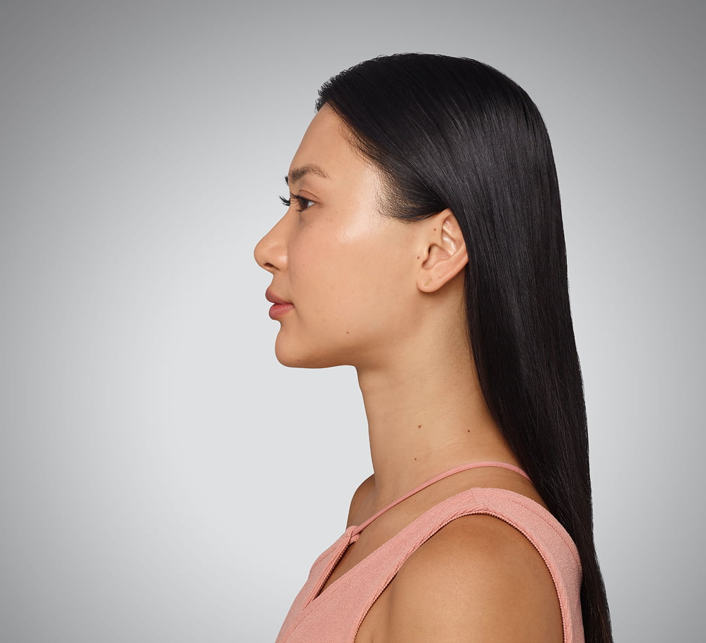 sara - cheeks, undereye, lips & jawline After Juvederm